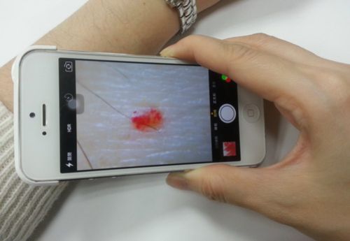 手機顯微鏡頭12倍拍攝: 微血管擴張
